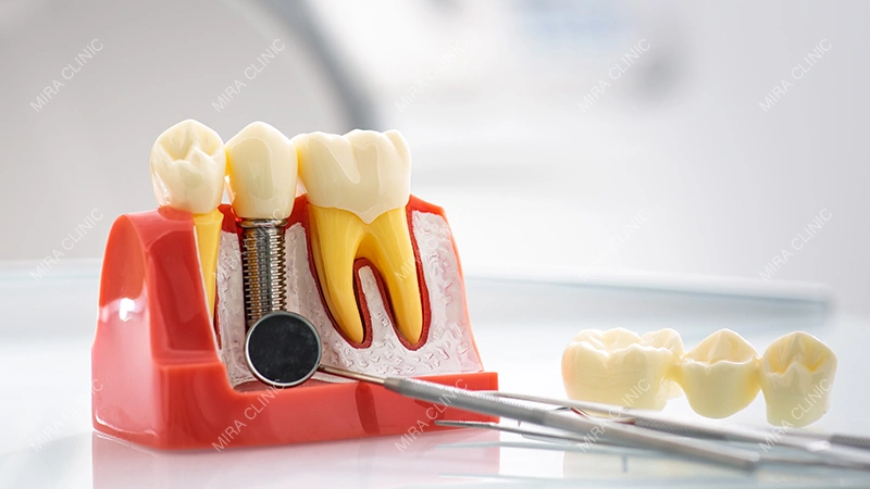 Dental Implant Restoration